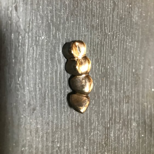 金歯