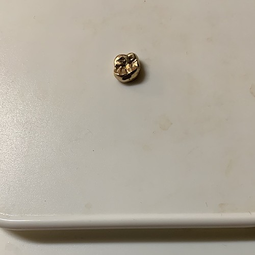 金歯クラウンとブリッジ(歯付)