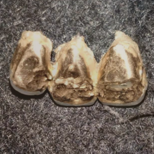 金歯
