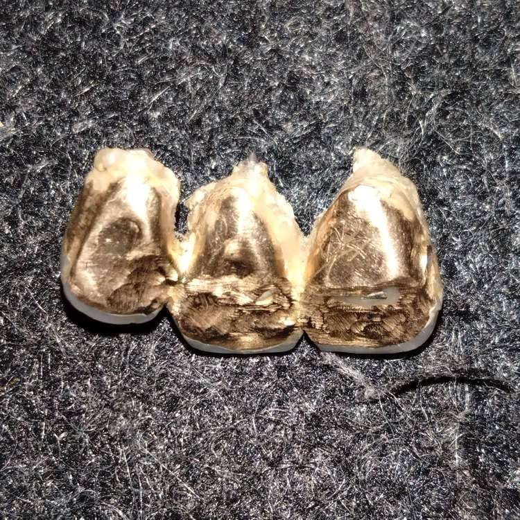 金歯