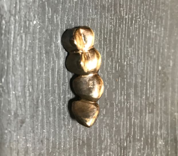 金歯