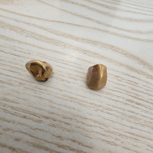 金歯（+リング）